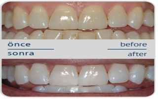 Diş Beyazlatma ( Bleaching ) Nedir ?