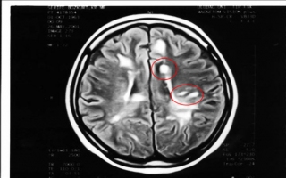 MS - MULTİPLE SKLEROZ - PLAK HASTALIĞI