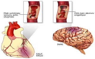 FELÇ (Stroke-İnme-Serebrovasküler olay)