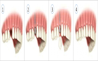 Diş İmplantı Tedavi Süreci