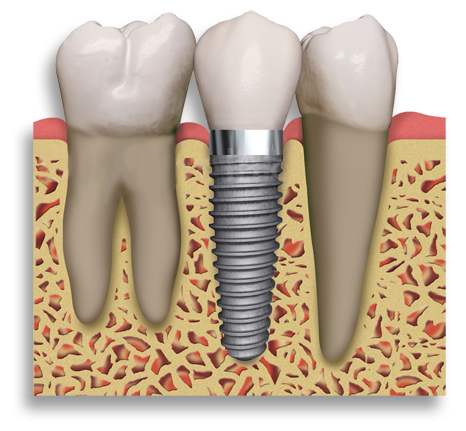 Dental ( Dişle ilgili) İmplantlar makalesi