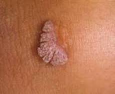 HPV,genital siğiller ve rahim ağzı kanseri
