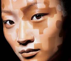 vitiligo, nedenleri ve tedavisi