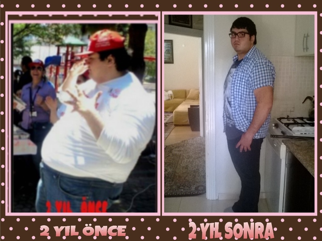 OBEZİTE ve TEDAVİSİ