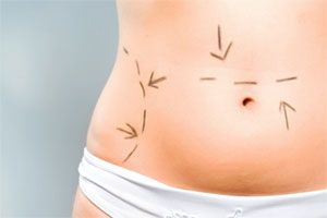 Liposculpture, estetik cerrahinin insan bedenine sanatsal dokunuşudur
