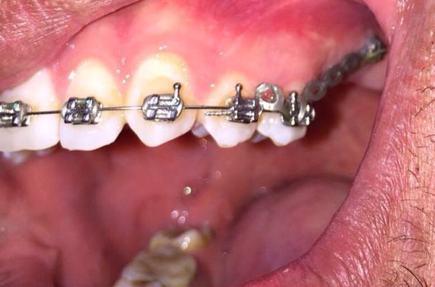 Ortodontik Tedavi Gören Hastalara Öneriler