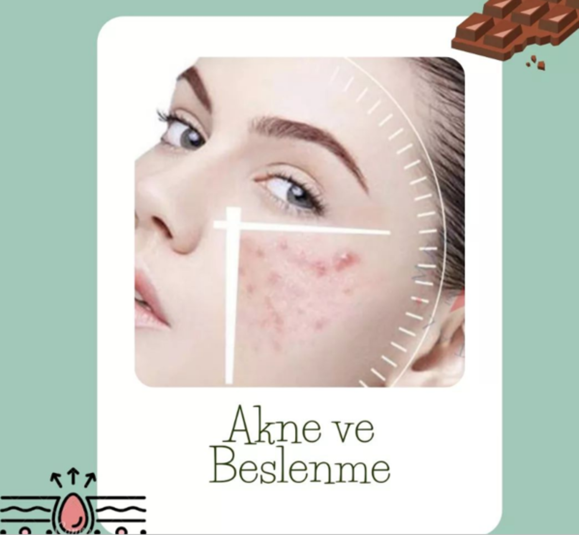 AKNE VE BESLENME