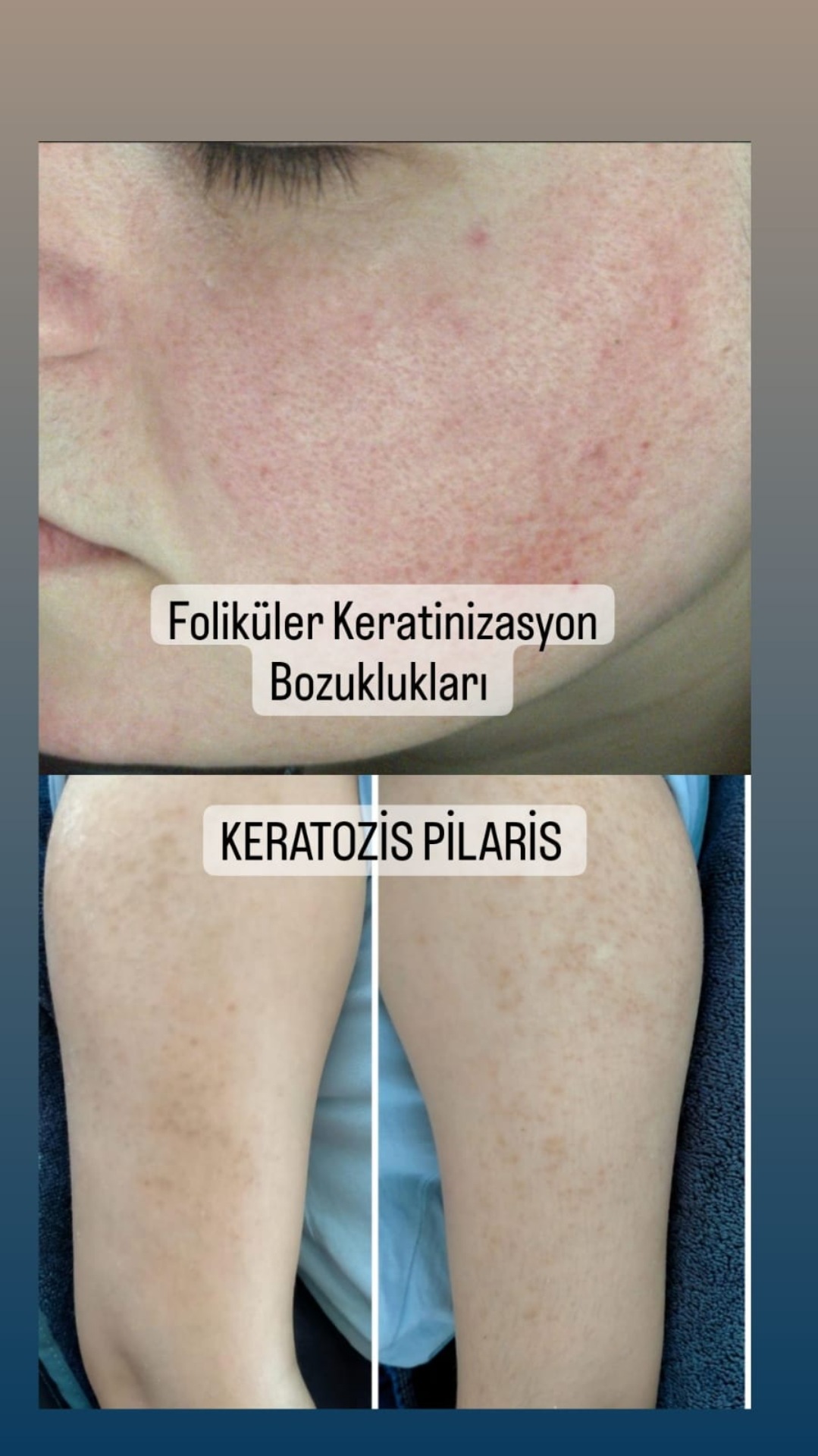 KERATOZİS PİLARİS