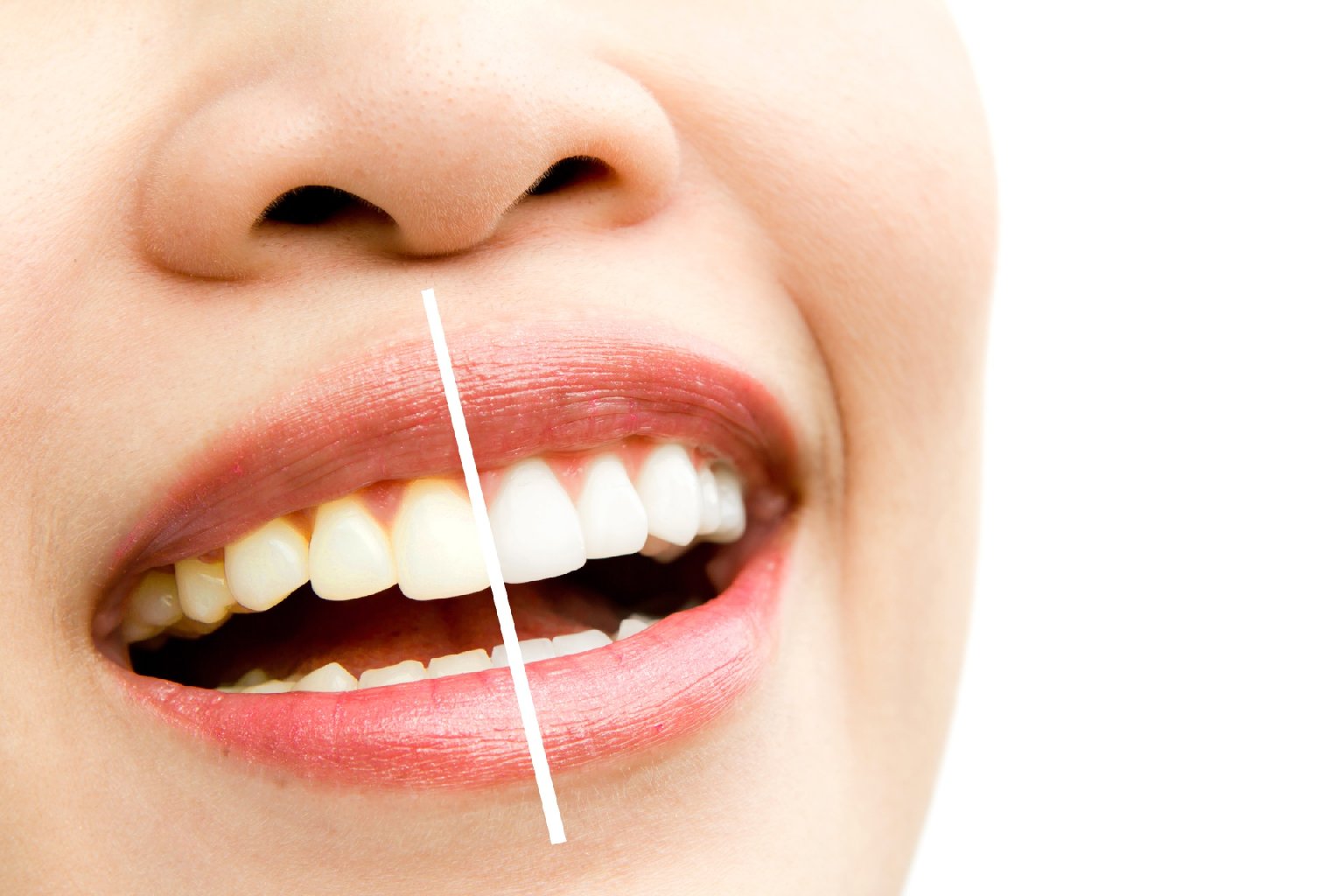 Diş Beyazlatma (Bleaching) Zararlı Mıdır ve Ne Sıklıkla Yapılmalıdır?