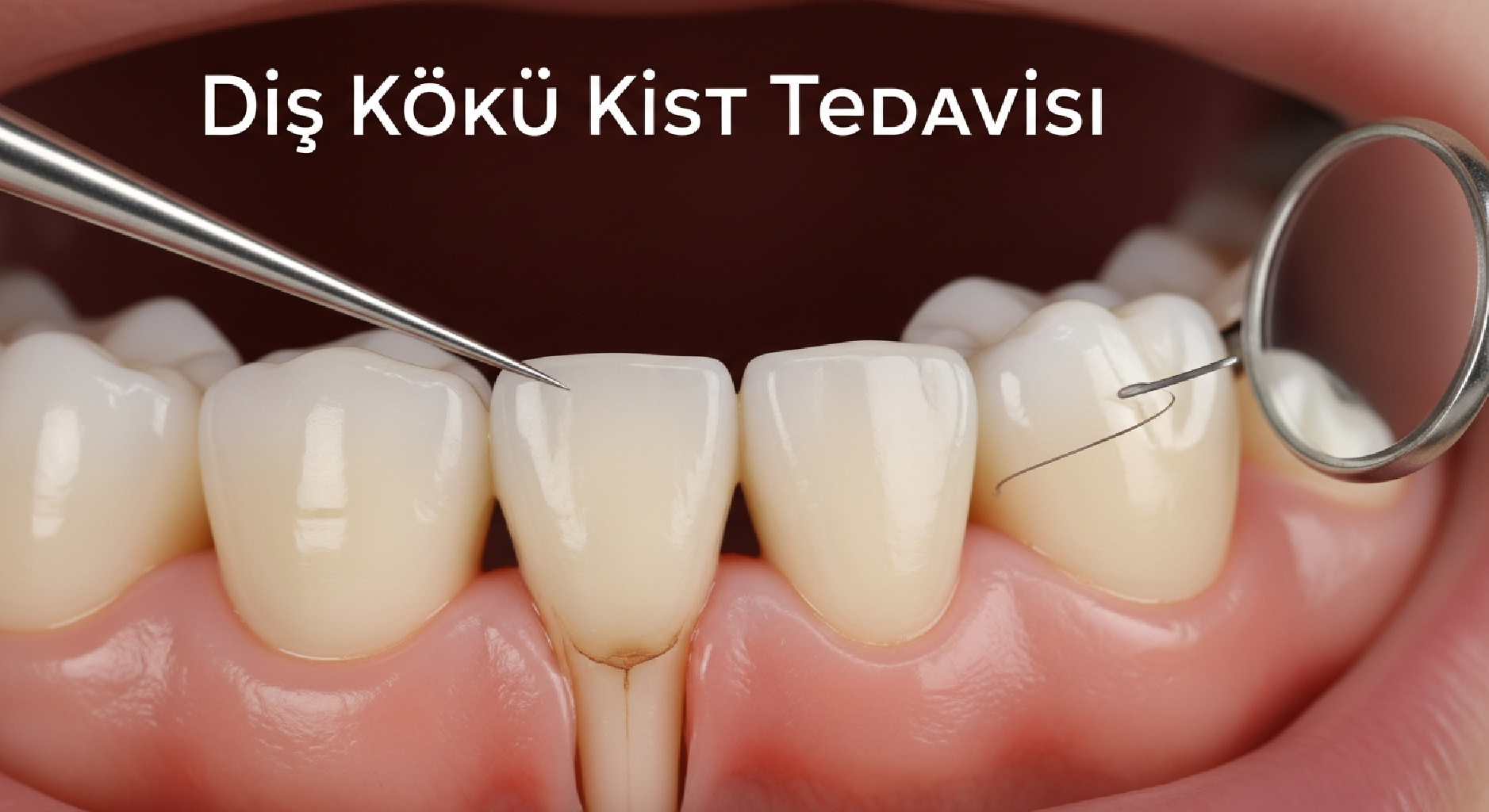 Diş Kökü Kist Tedavisi: Neden Önemlidir ve Nasıl Planlanır?