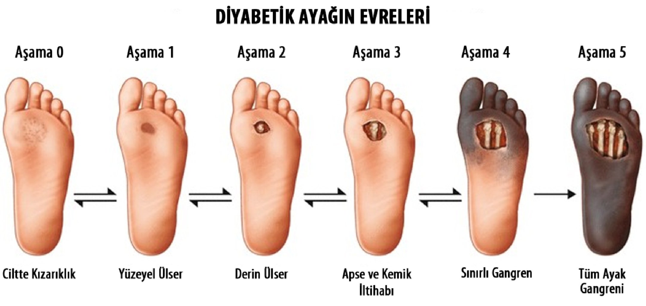 Diyabet Hastaları Mutlaka Bilmesi Gerekenler