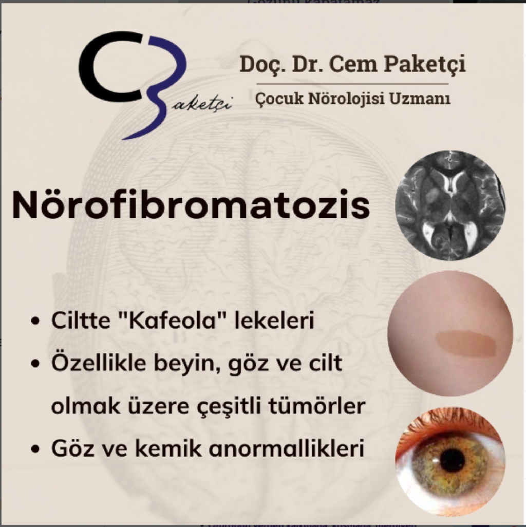 Nörofibromatozis