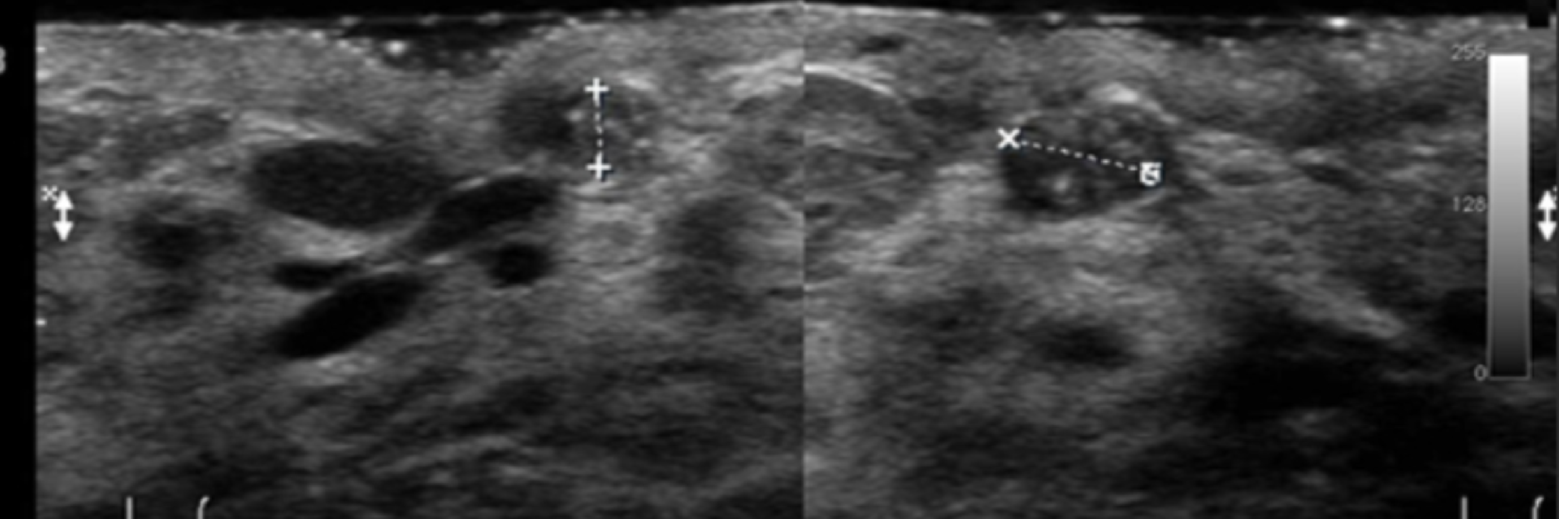 Fibroadenom ile Meme Kanseri İlişkisi