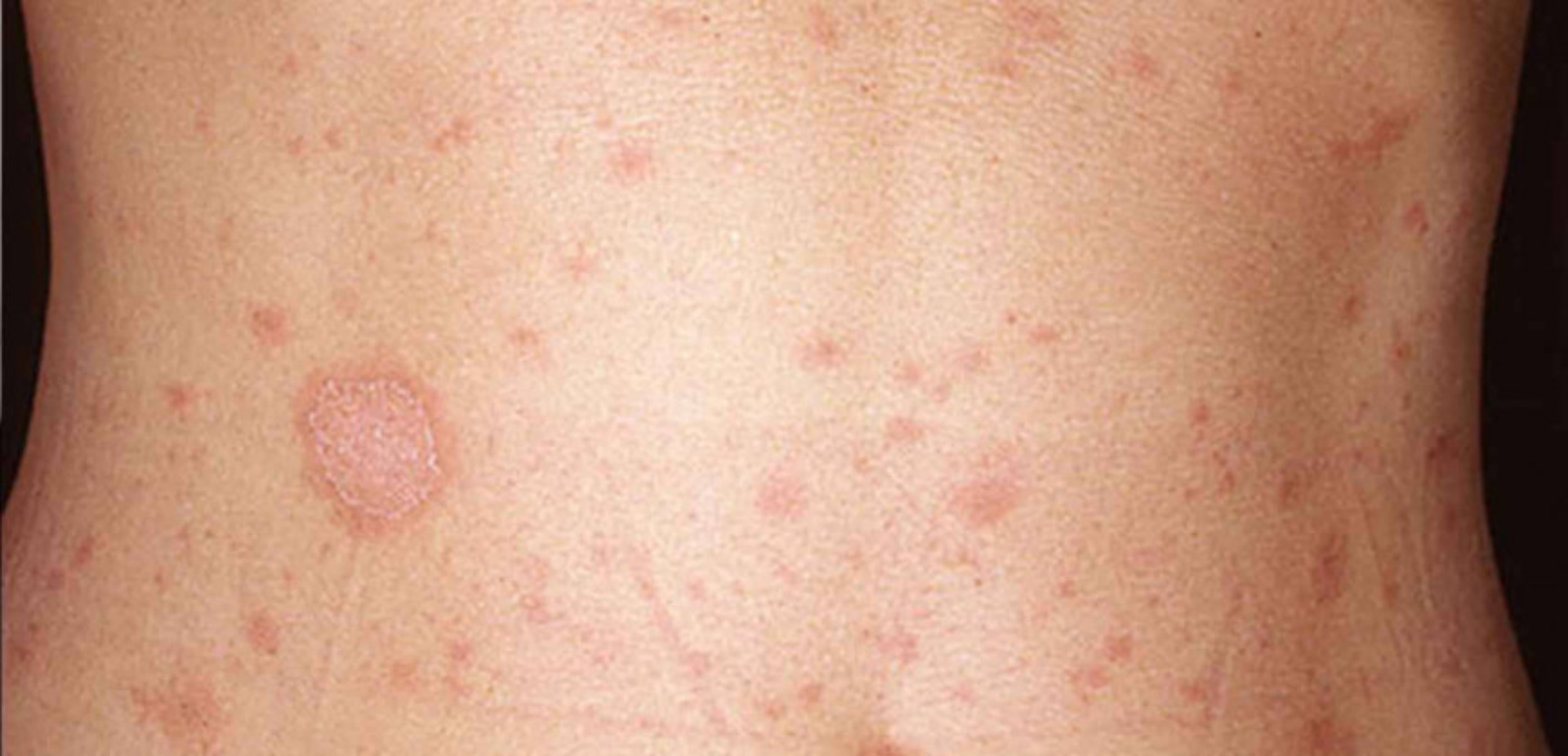 Pityriasis rosea: a natural history of pediatric cases in the Central Anatolia Region of Turkey