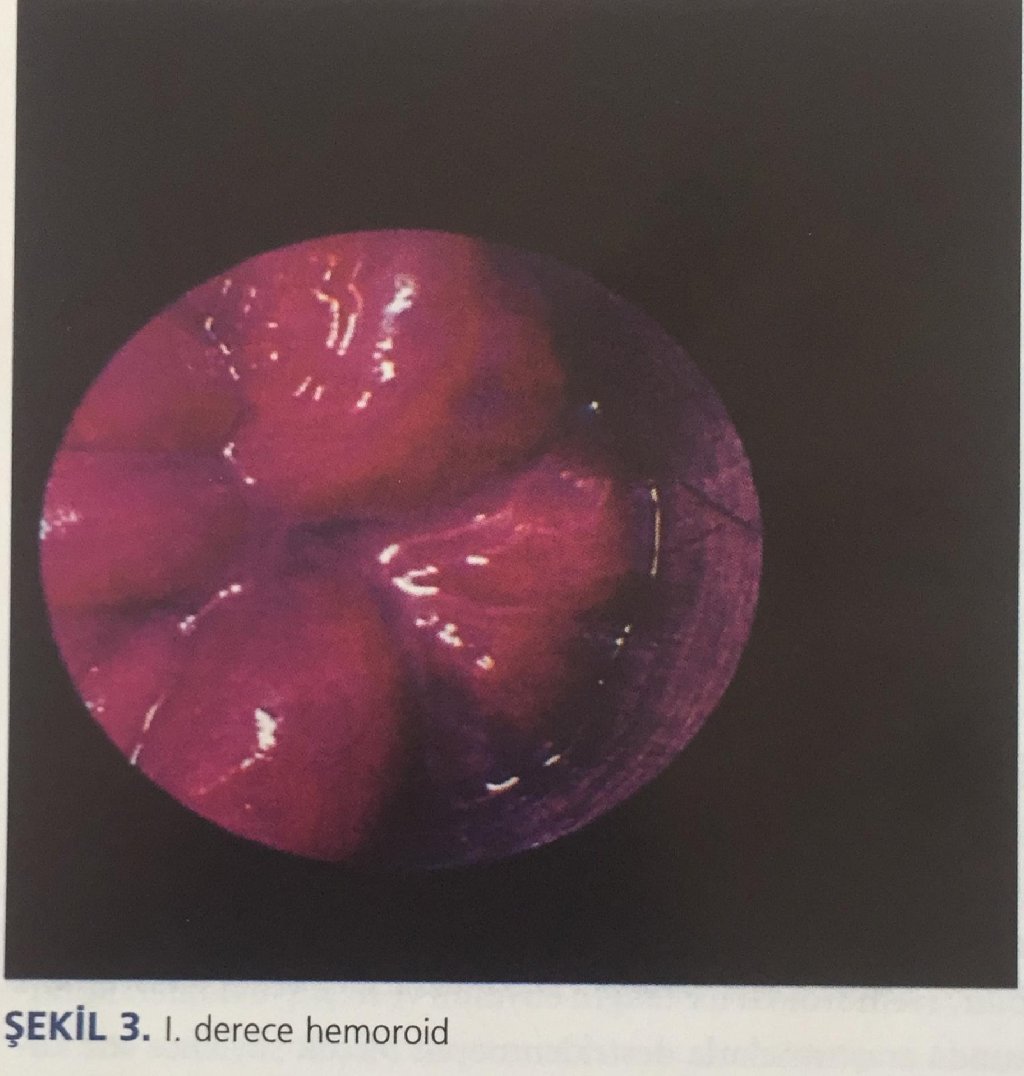 HEMOROİDAL HASTALIK
