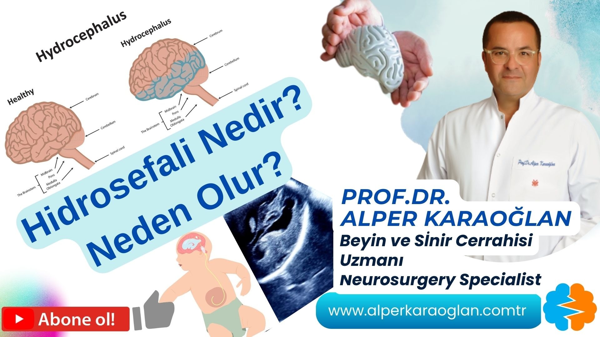 HİDROSEFALİ Hastalığı Nedir? Neden Olur?