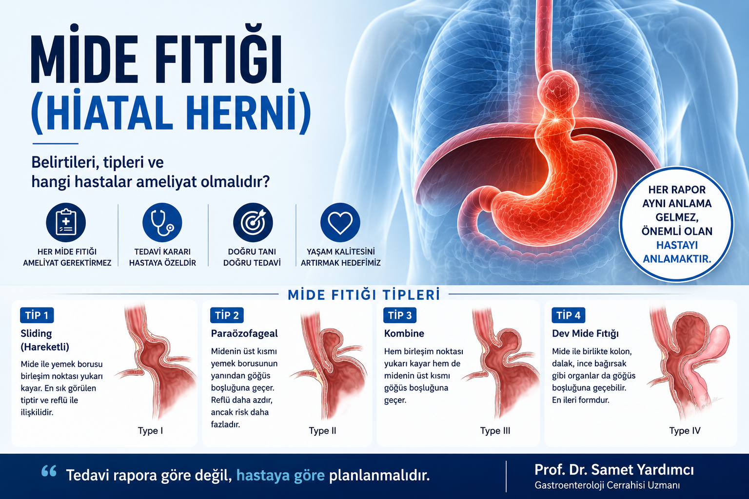 Mide Fıtığı (Hiatal Herni) Nedir?