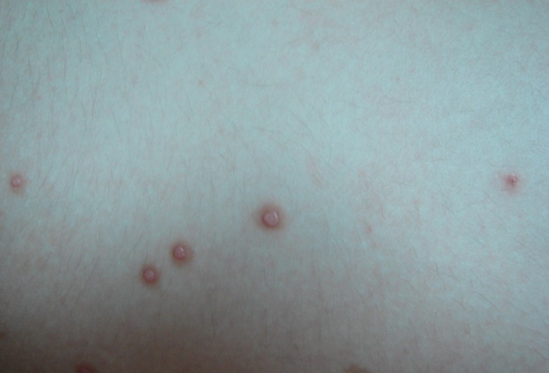 MOLLUSCUM CONTAGİOSUM