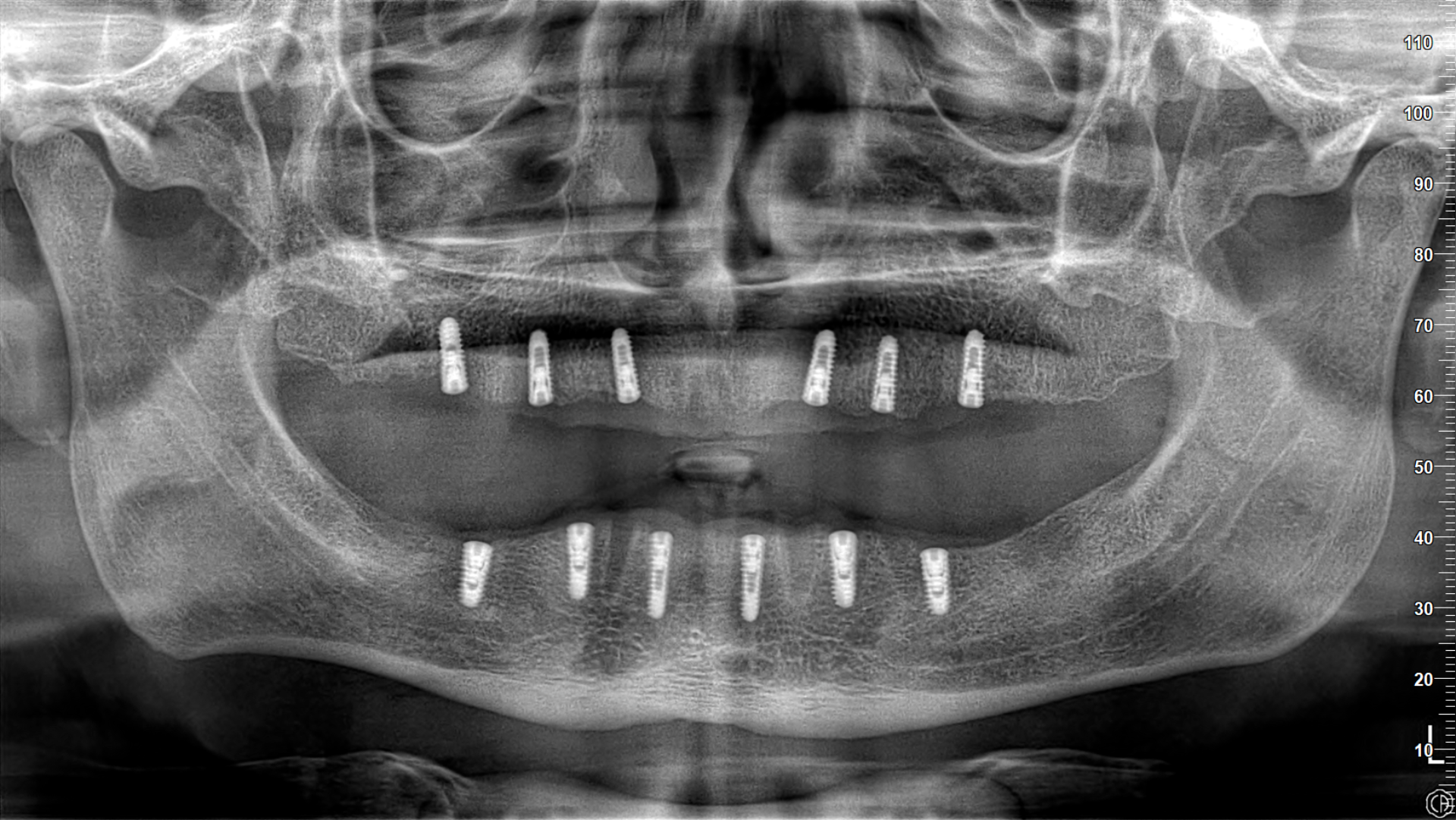 Dental İmplant makalesi