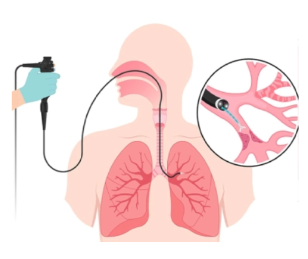Endobronşiyal Ultrason (EBUS): Akciğerlerin Gizemli Dünyasına Yolculuk makalesi