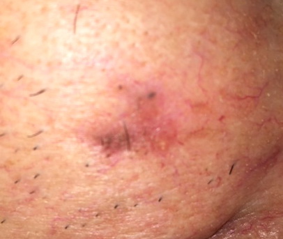 ERKEN EVRE MELANOM DIŞI DERİ KANSERİNDE  (MDDK) KİŞİYE ÖZEL  TEDAVİ   Prof.Dr.Sıdıka Kurul Plastik Rekonstrüktif ve Estetik Cerrahi Uzmanı  skurul@estet.net