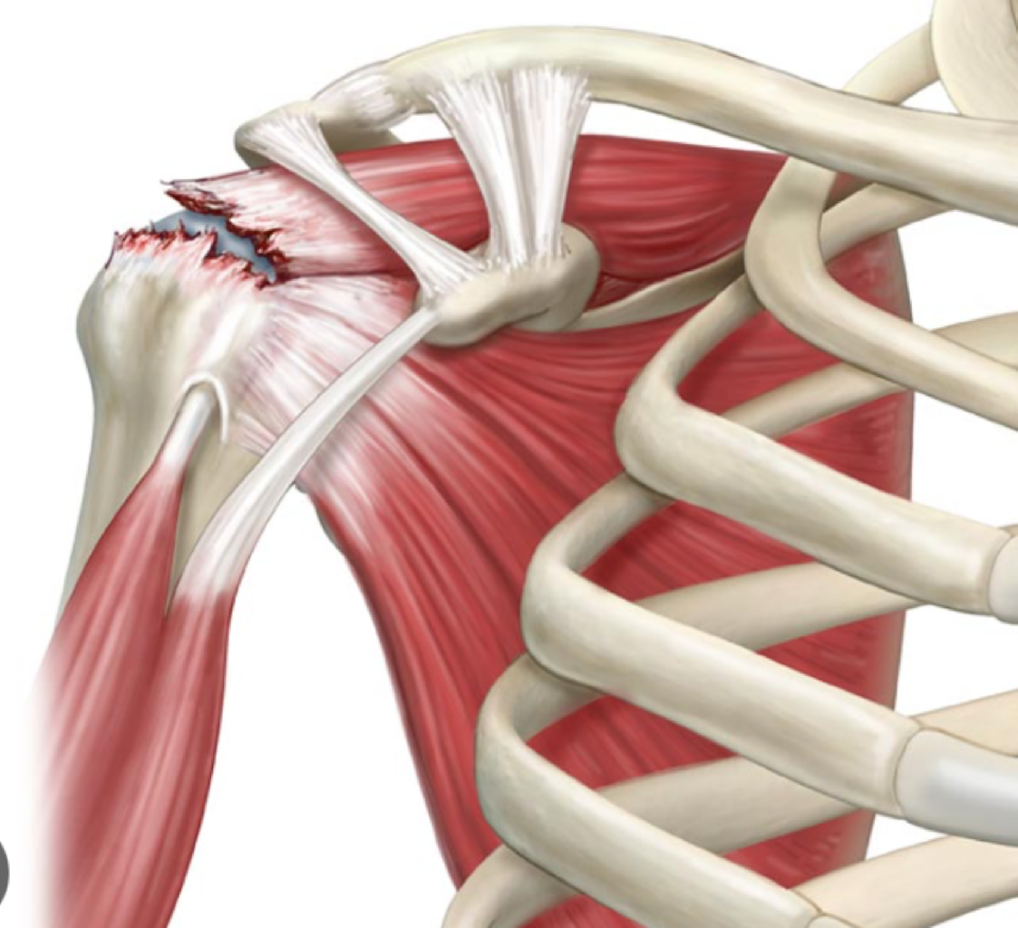 Omuzda Kas Yırtığı (Rotator Cuff Yırtığı) Hakkında Bilmeniz Gereken Her Şey