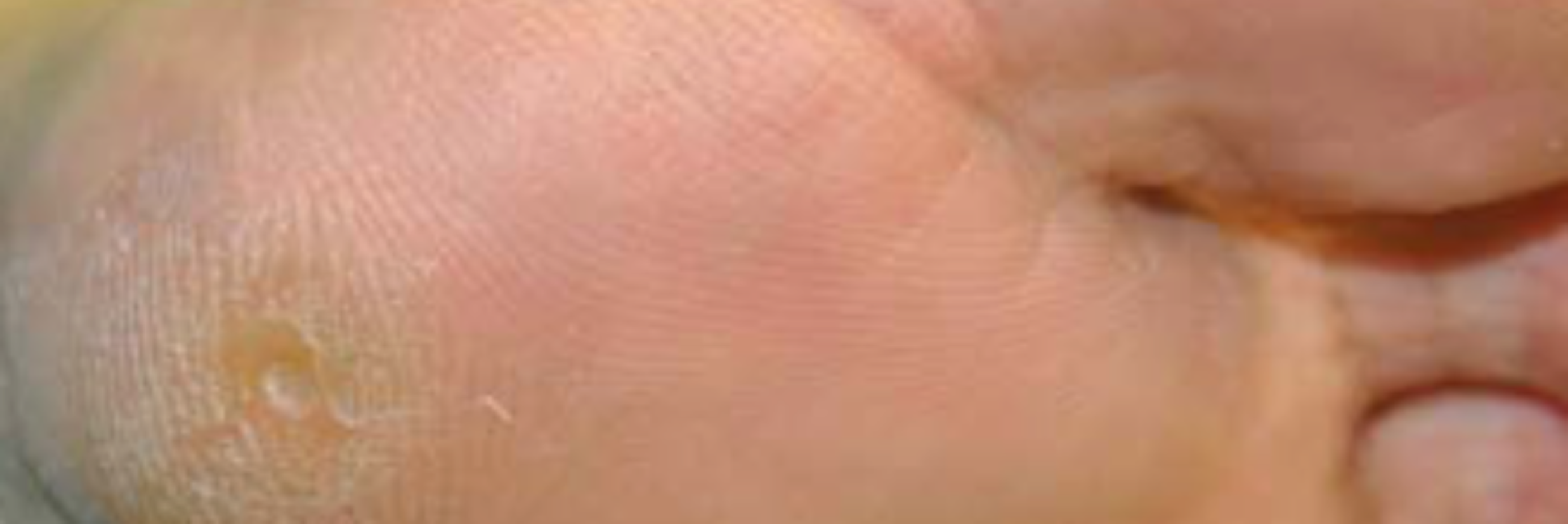 Bizarre parosteal osteochondromatous proliferation (Nora's lesion) in the medial sesamoid of the first toe