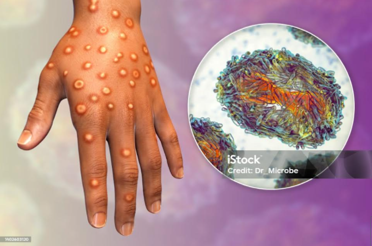Monkeypox (Maymun Çiçeği Virüsü)