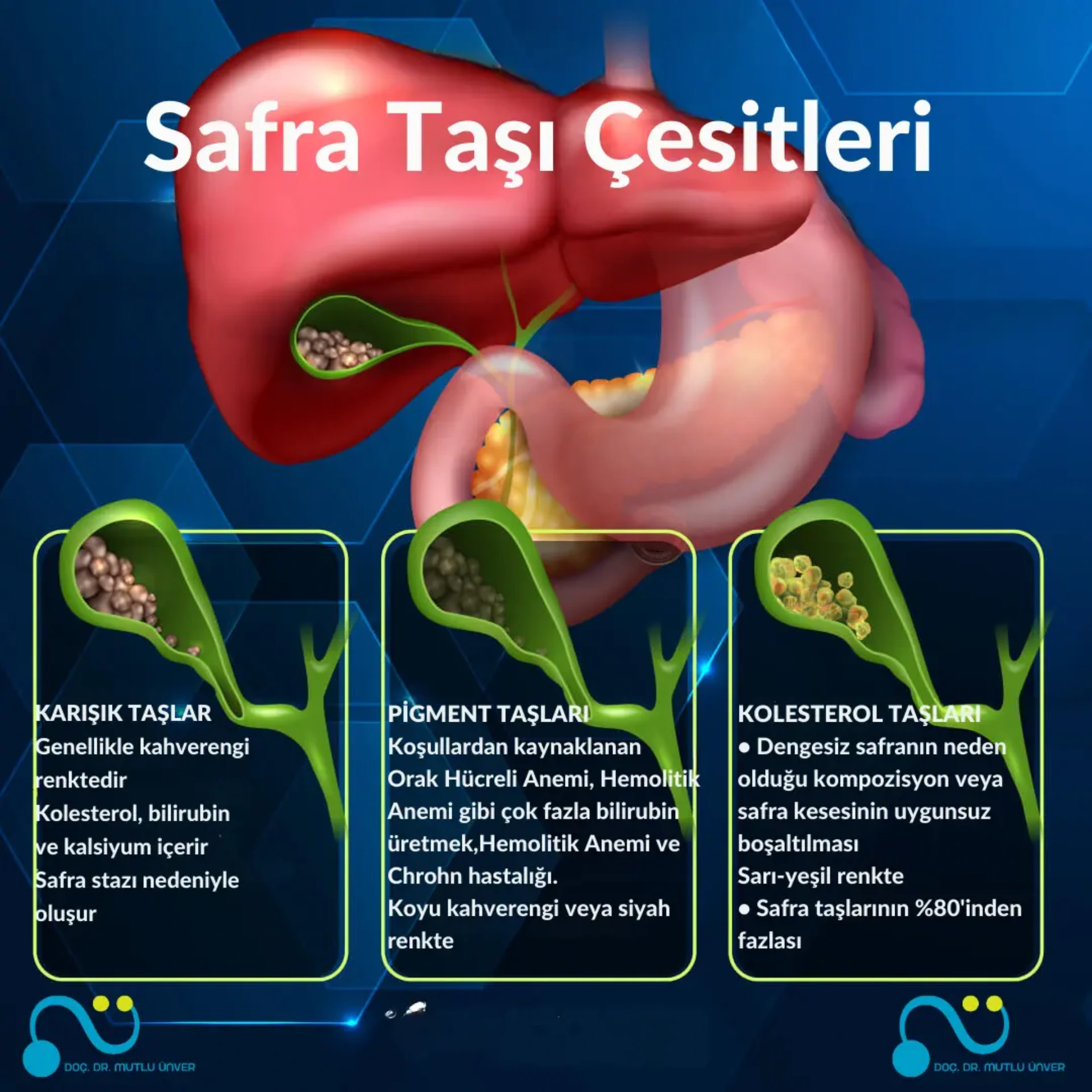 Safra Kesesi Taşı : Tanı ve Tedavi Yöntemleri makalesi