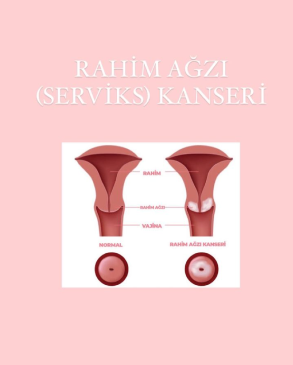Rahim Ağzı Kanserinin İlk Belirtileri Nelerdir? makalesi