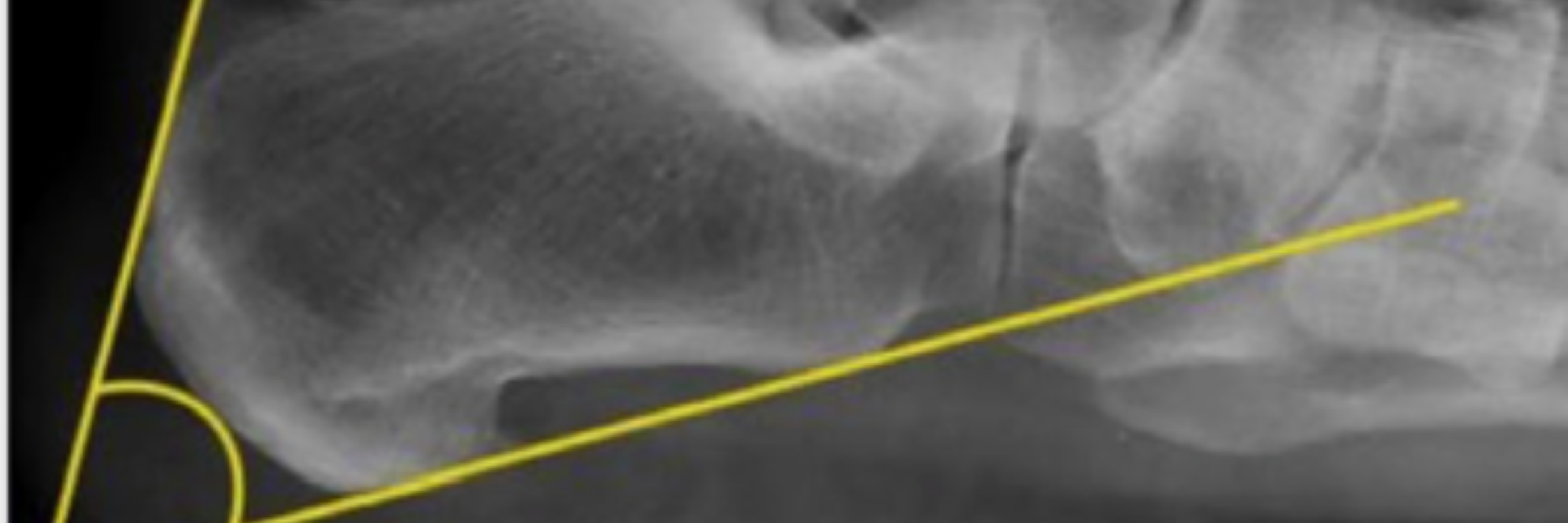 Assessment of Calcaneal Morphology and Radiological Parameters in Haglund’s Syndrome