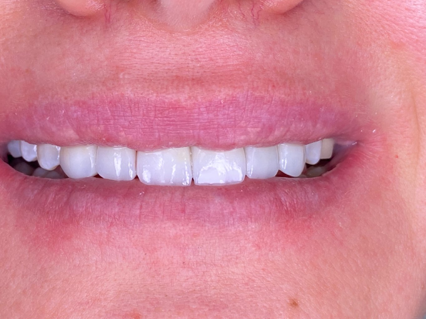 Gülüş Tasarımı Sonrası: Sağlıklı ve Etkili Bakım İpuçları