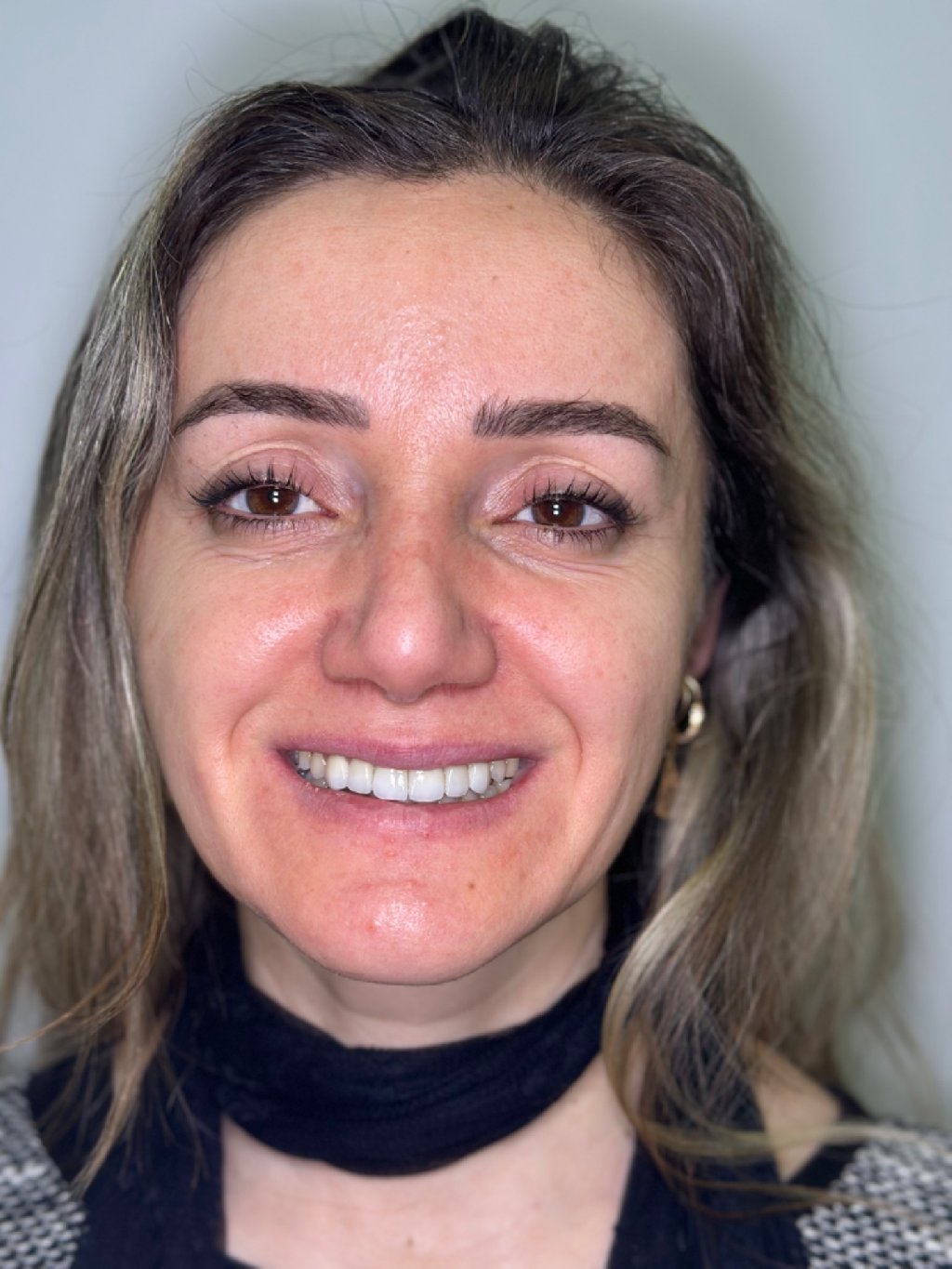 Yüz Estetiği ve Gülüş Tasarımı: Bir Bütünün Parçaları