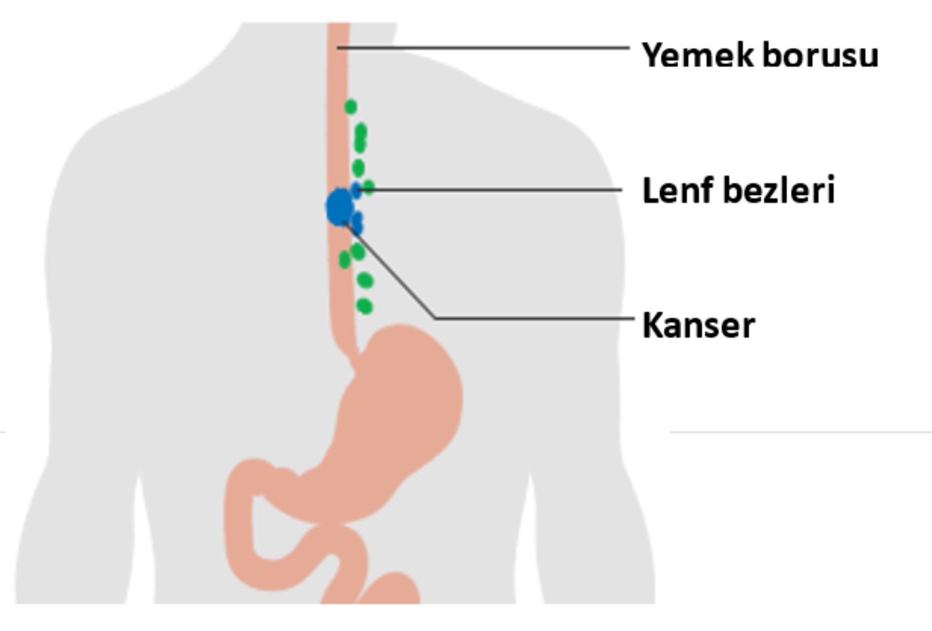 Yemek Borusu Kanseri