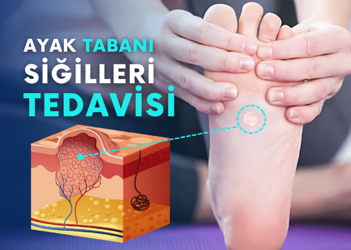 Siğil Tedavisi Hakkın da En Çok Merak Edilenler