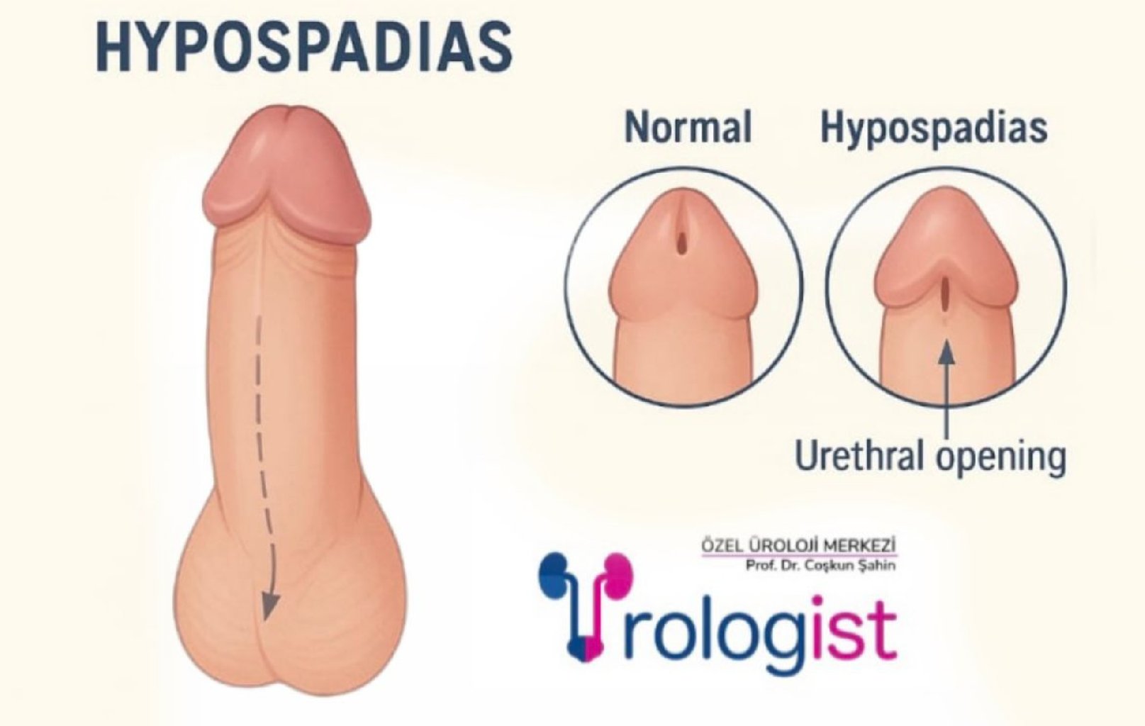 Hipospadias Nedir? Belirtileri, Erken Teşhisi ve Tedavi Süreci makalesi