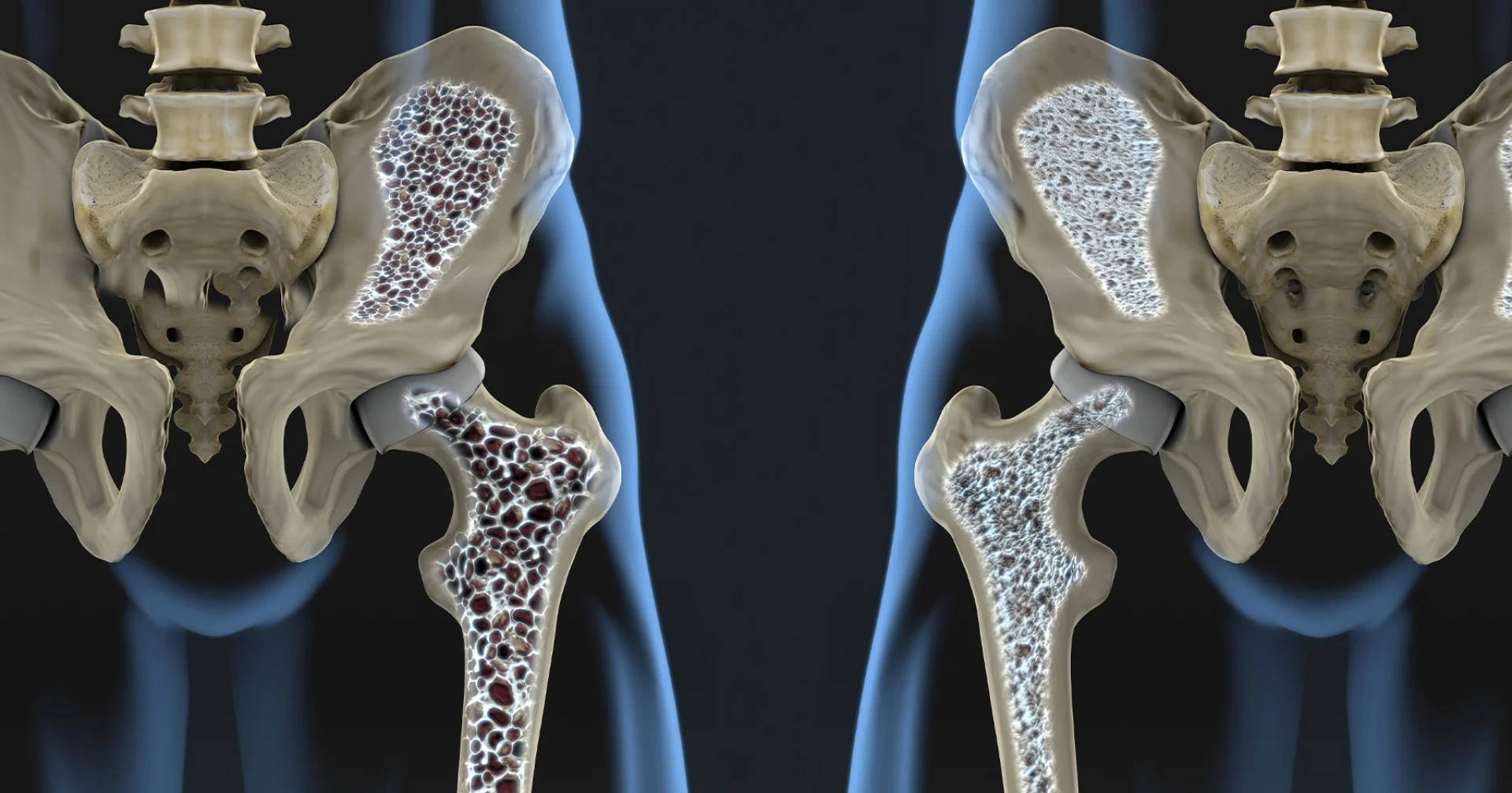 Osteoporoz (Kemik erimesi)