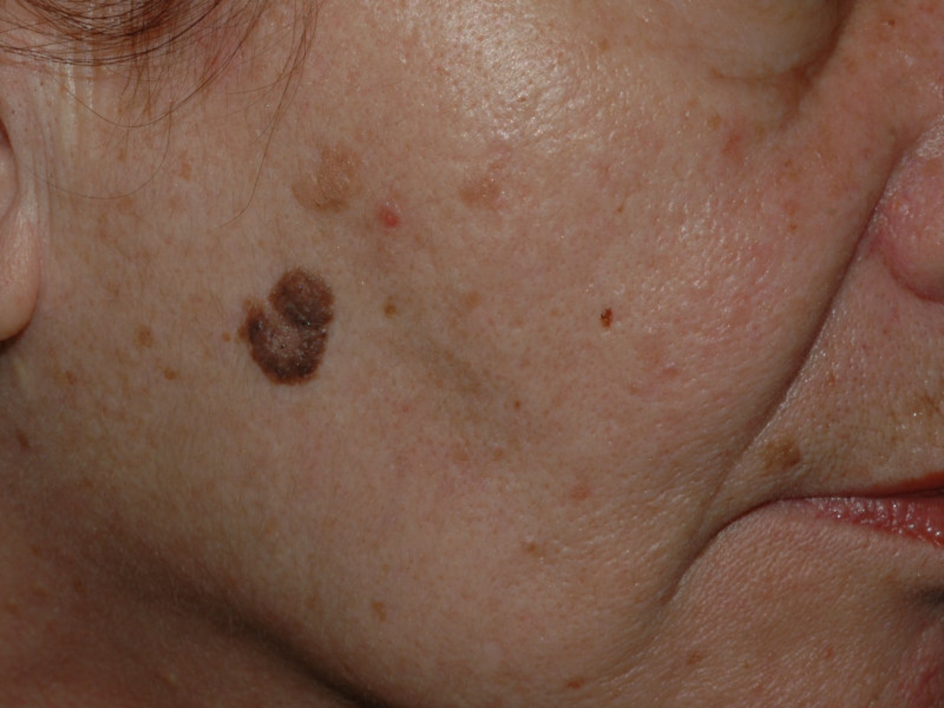 Malignant Melanoma