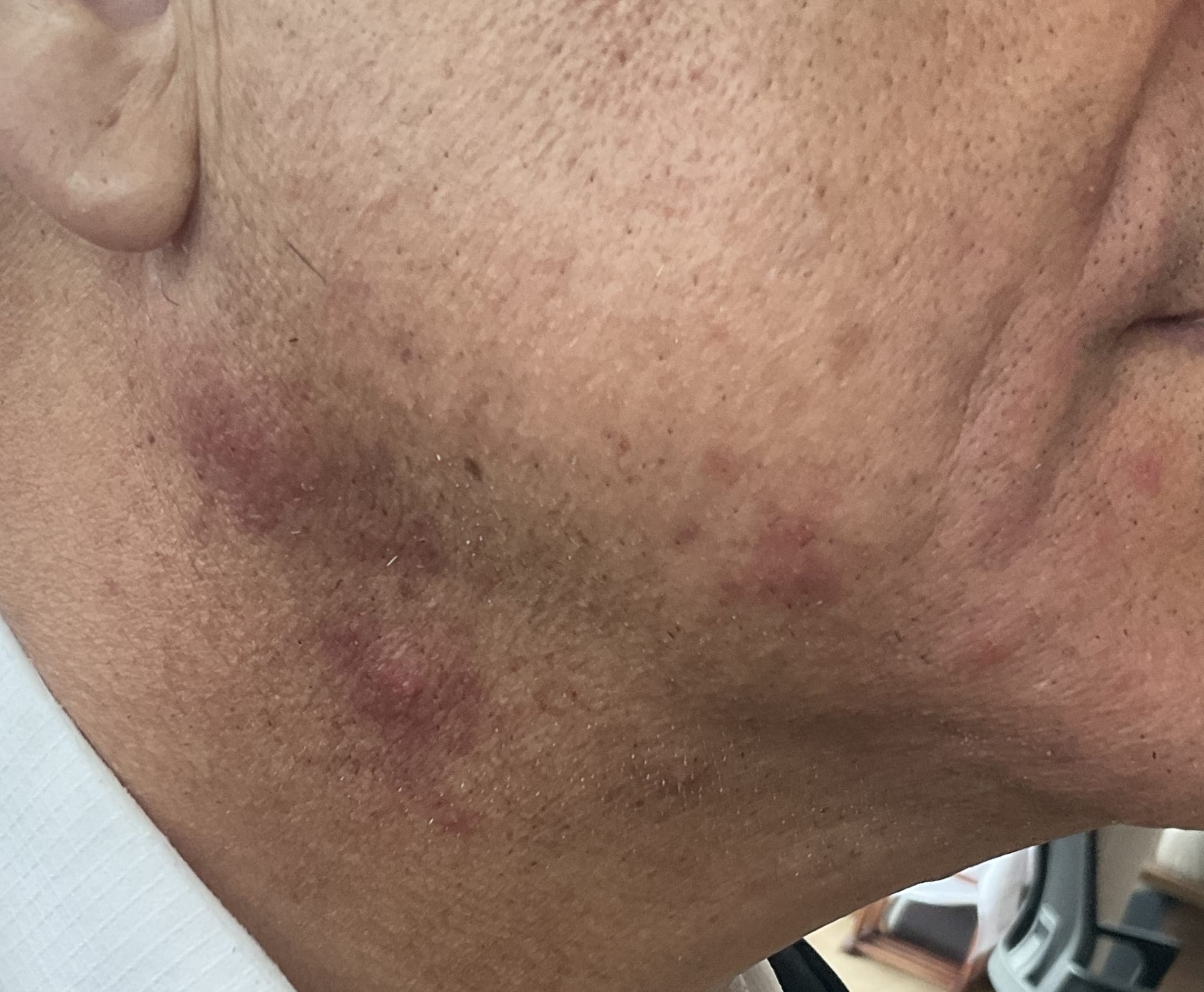PSODOFOLİKÜLİTİS BARBA YANİ TIRAŞ ŞİŞLİKLERİ