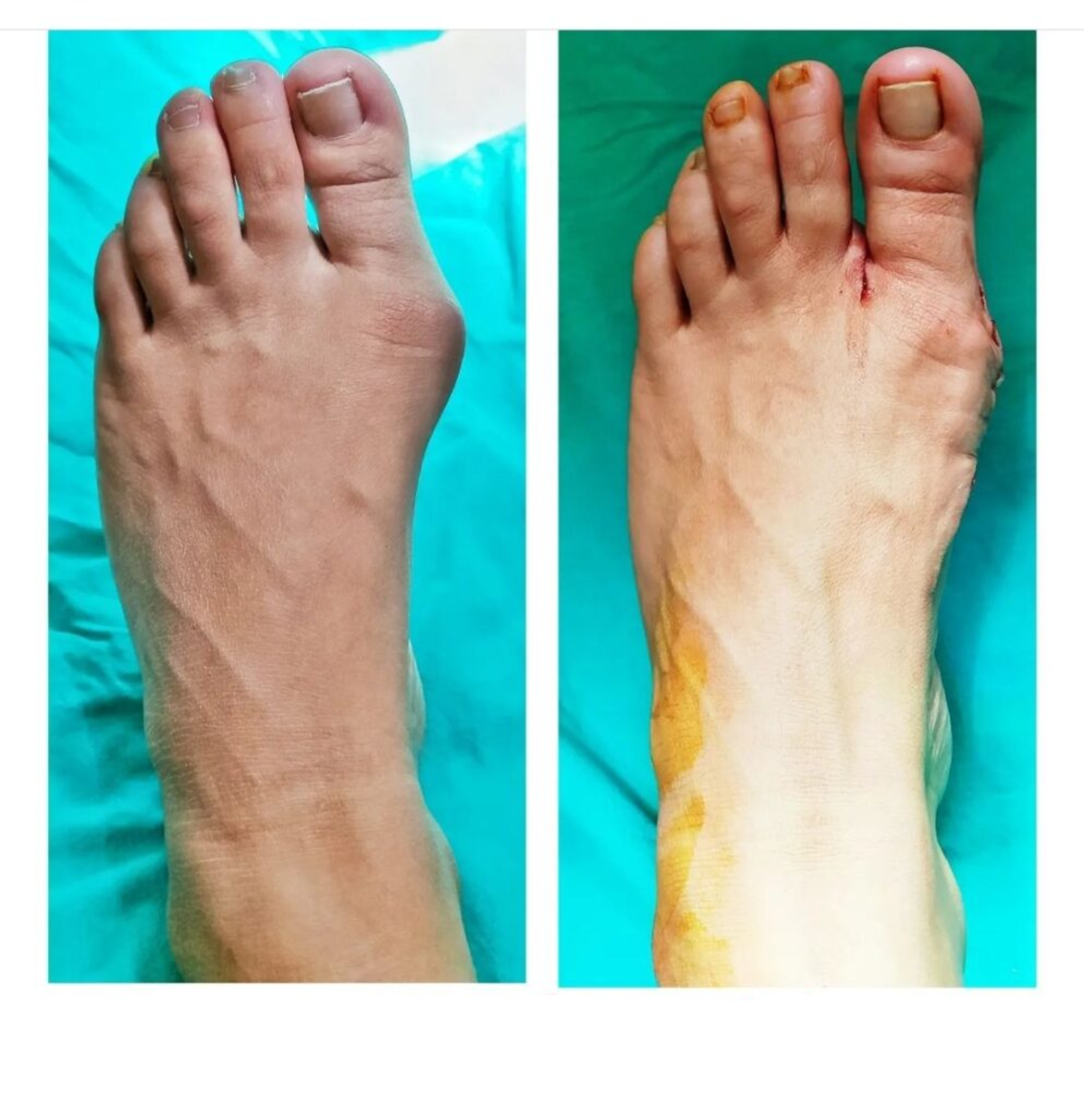 HALLUKS VALGUS / AYAK BAŞPARMAK ÇIKINTISI makalesi