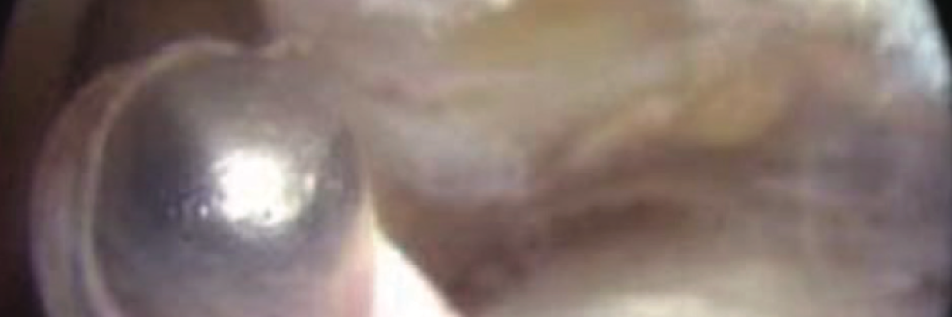 Endoscopy-assisted percutaneous repair of Achilles tendon rupture