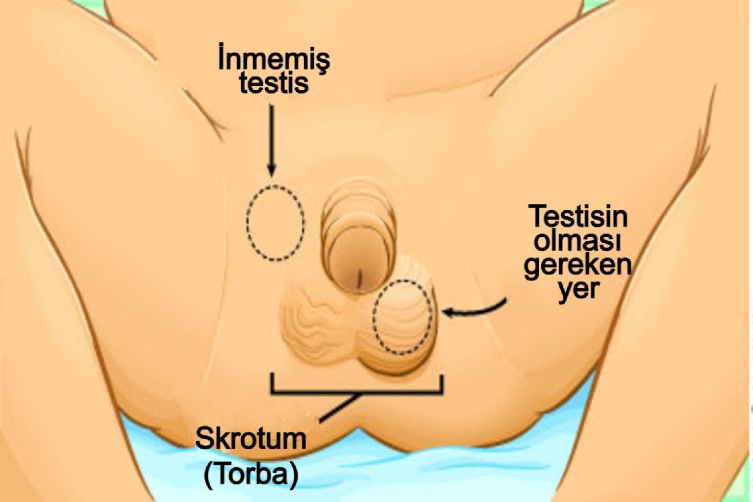 İnmemiş testis (kriptorkidizm) ve asansör testis (retraktil testis) nedir?