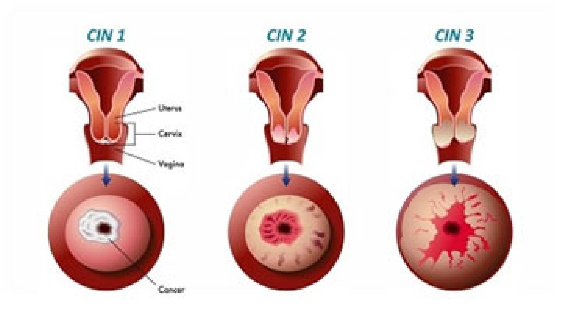 CIN 1. 2. 3