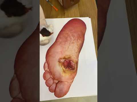 Diyabetik ayak yarası PRP uygulaması