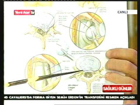 Bel Fıtığı ve Tedavisi (Dr. Haluk Özer) - 2