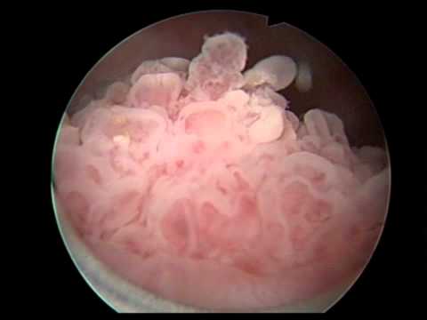 Profesör Doktor Mete KİLCİLER - Divertikül İçinde Mesane Tümörü