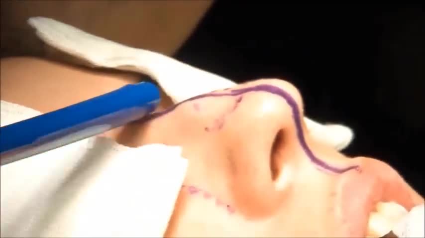 Burun Estetiği Ameliyat Videosu Op.Dr.Defne Erkara