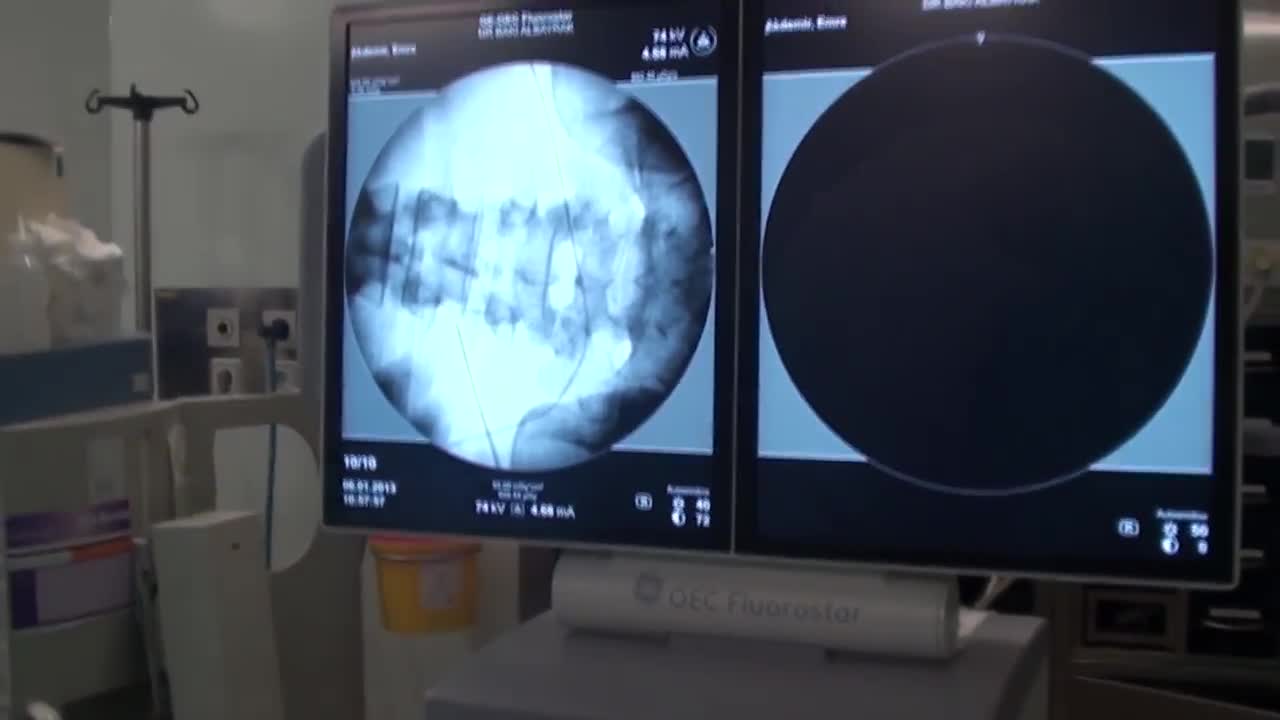 Doç. Dr. S. Baki Albayrak - Lomber Transforaminal Epidural Kök Blokajı