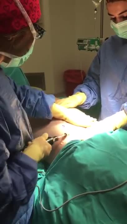 VASER Liposuction Ameliyatı