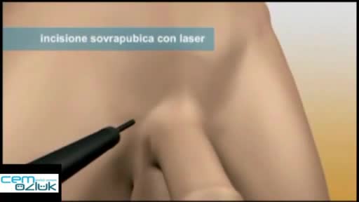 Penis Büyütme (Penoplasty - Penis Lengthening)